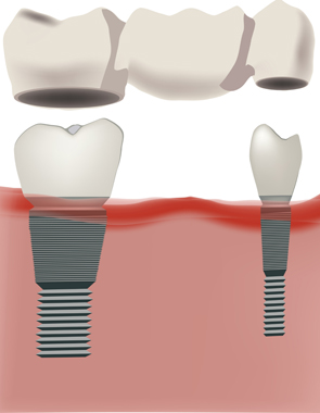 Dental Bridges