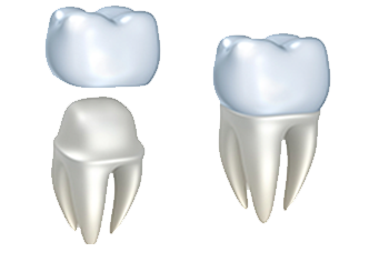 Porcelain Dental Crowns